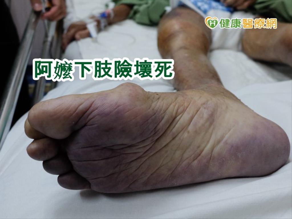 阿嬤下肢缺血險壞死　微創導管清除血栓