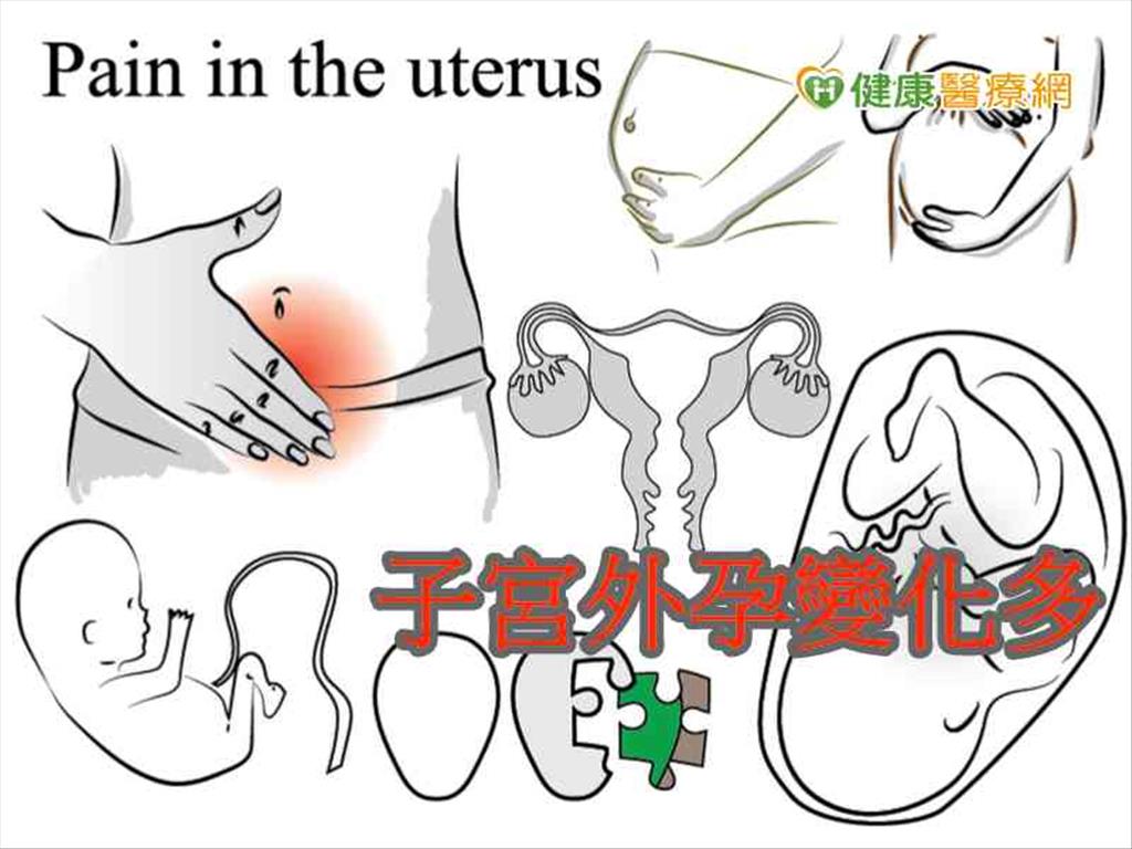 非經期出血或懷孕找不到肧胎　小心子宮外孕