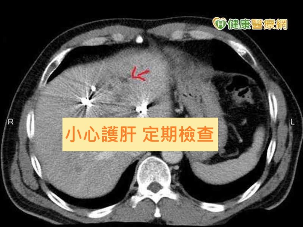  以為只是「腹痛 」　竟是肝癌惹禍