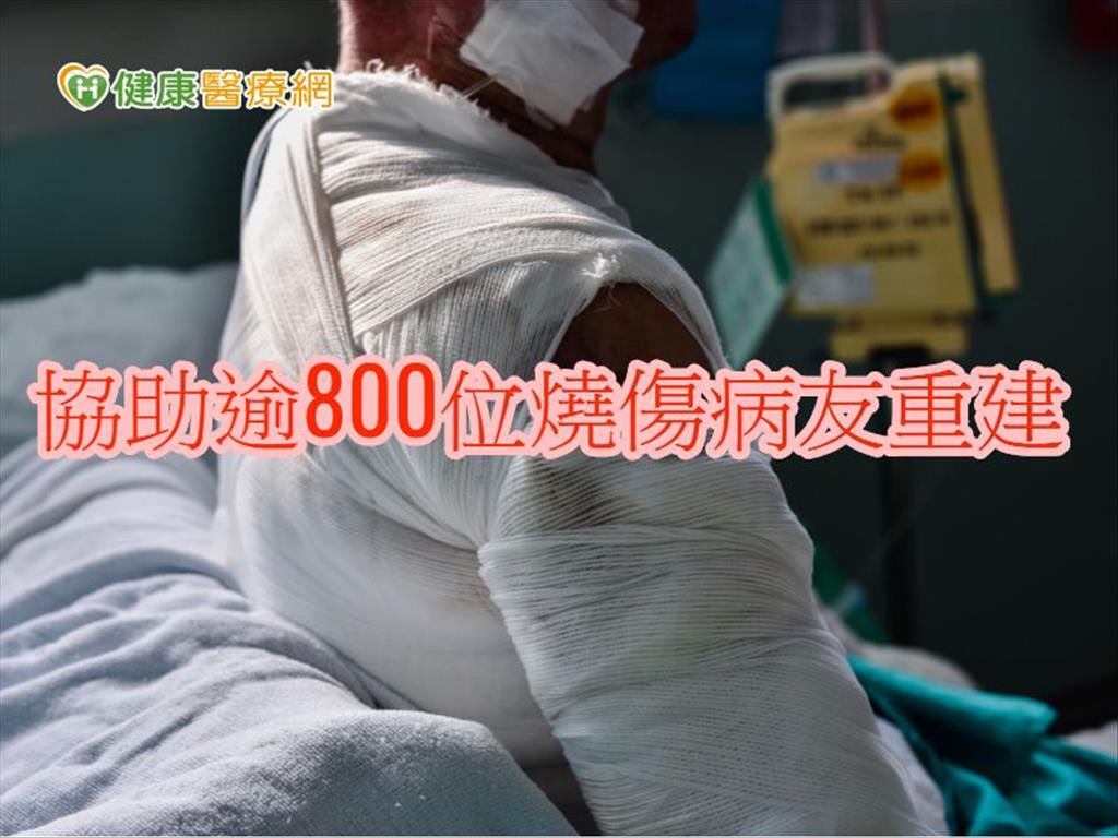 全身八成燒傷躲過死神　復健路漫長盼鼓勵