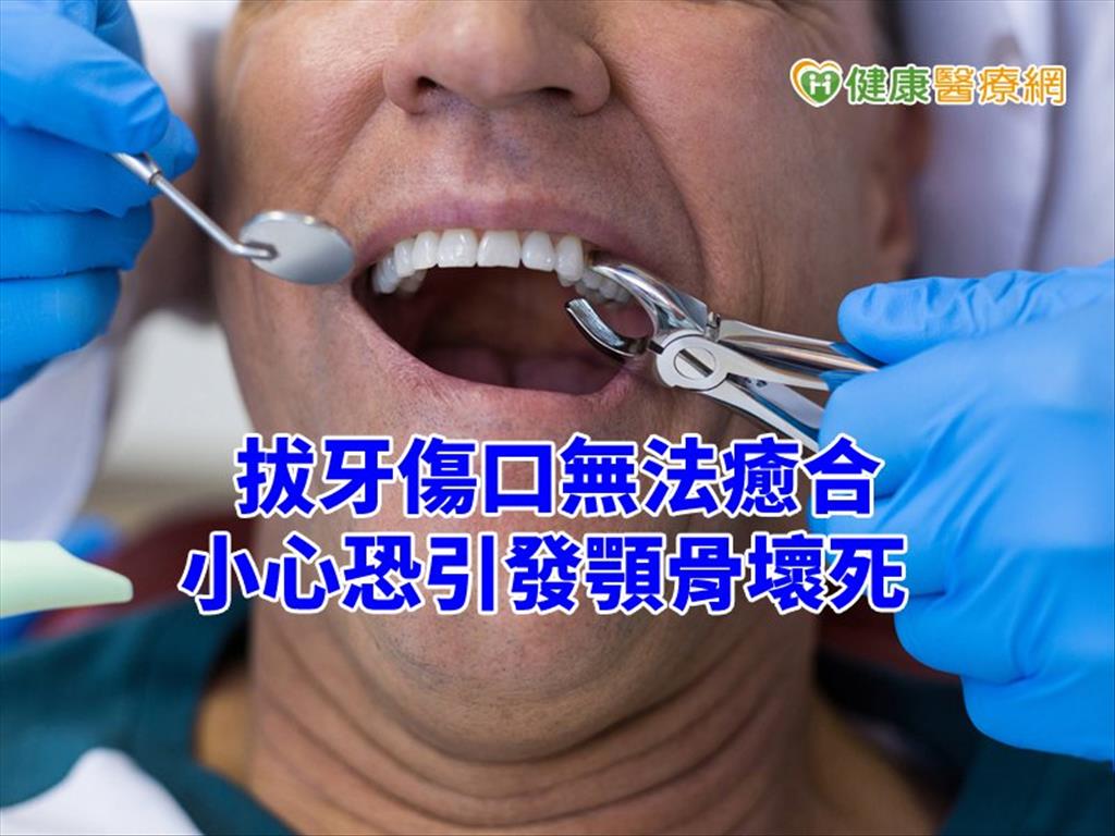 拔牙後傷口加劇　原來是「這成分」副作用惹禍