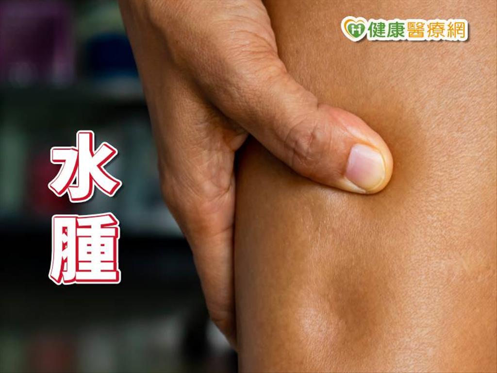 水喝多了也會腫？　教你消「水腫」妙招