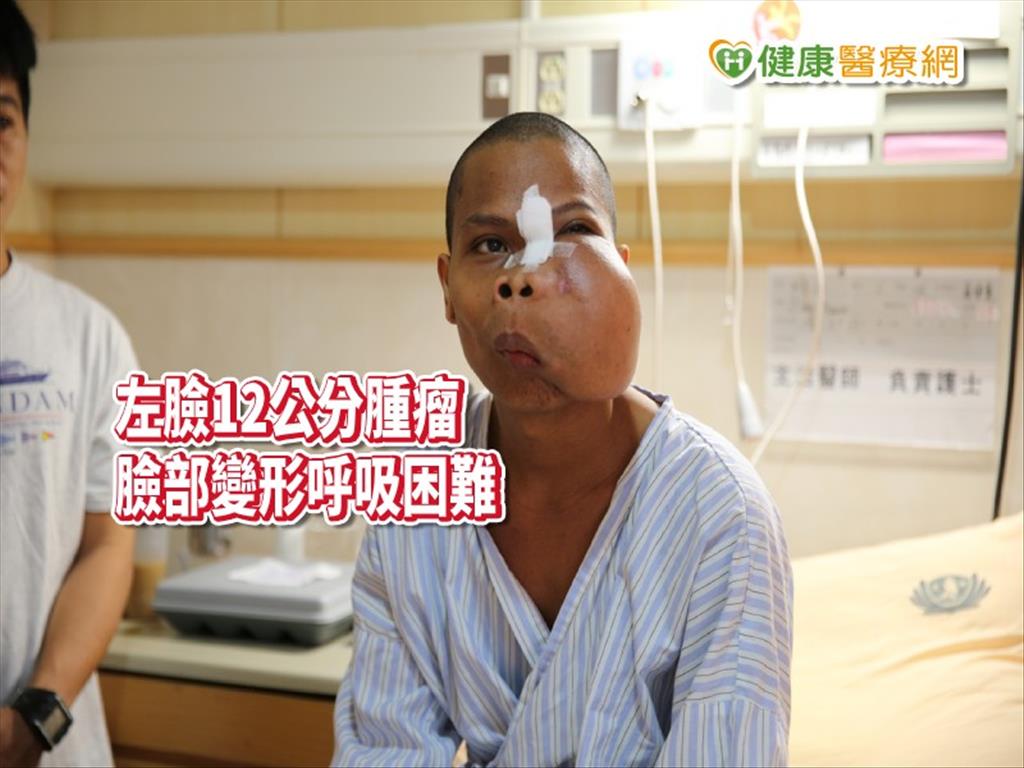 巨大腫瘤吃掉左臉！菲男跨海求「變臉」重生