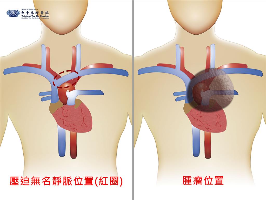 腫瘤壓迫無名靜脈位置示意圖。