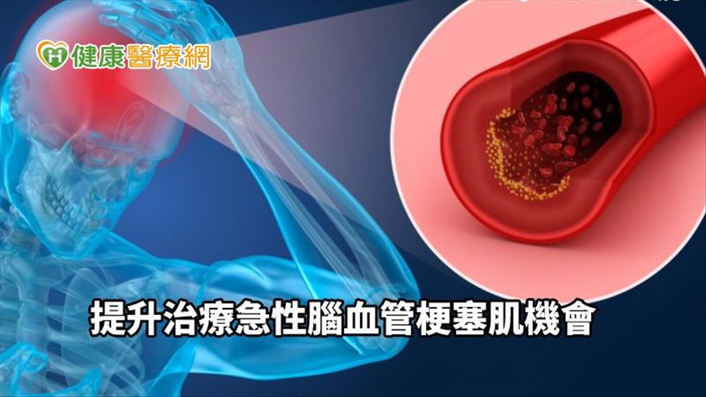 治療急性腦血管梗塞　研究：使用機械取栓器提升預後