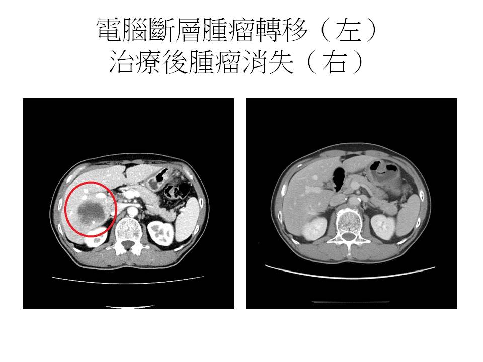 治療前與後電腦斷層對照