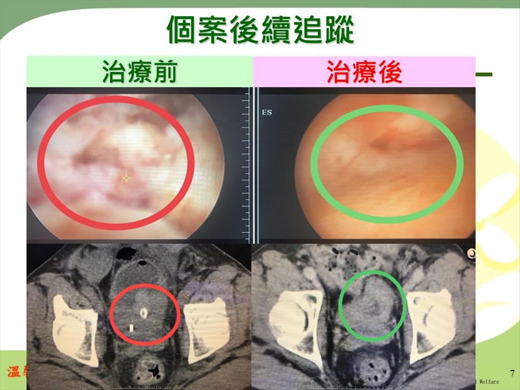 廖志穎主任指出，病患接受整合四合一療法後腫瘤已縮小至1.5公分內