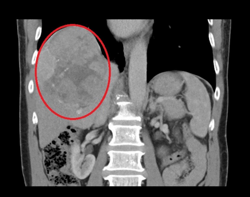 電腦斷層檢查肝腫瘤達13公分（紅框）。